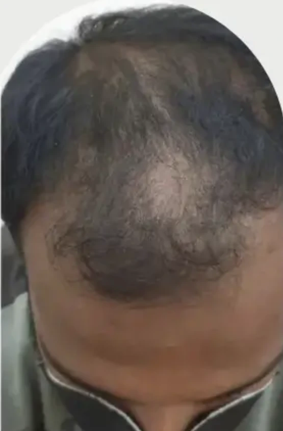 Male Pattern Baldness case 6 before treatment